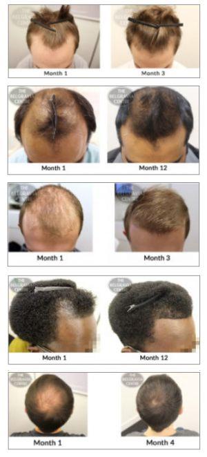 men's hair regrowth