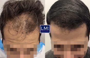 Hair loss recovery products for men over 40