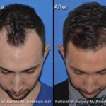 How to restore hair density for men over 40