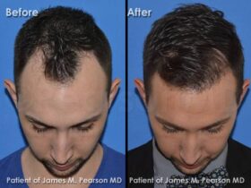 How to restore hair density for men over 40