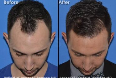 How to restore hair density for men over 40