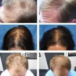 Laser hair growth therapy for men over 40