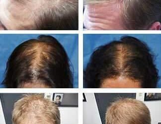 Laser hair growth therapy for men over 40