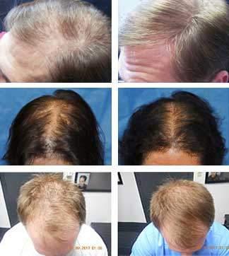 Laser hair growth therapy for men over 40