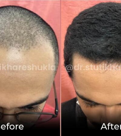 Best non-surgical options for hair growth in men over 40