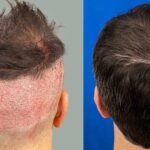 Hair transplant for men over 40