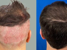 Hair transplant for men over 40