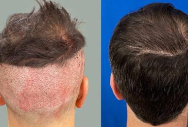 Hair transplant for men over 40