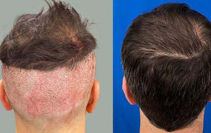 Hair transplant for men over 40