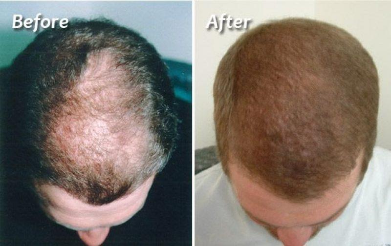 non-surgical hair growth