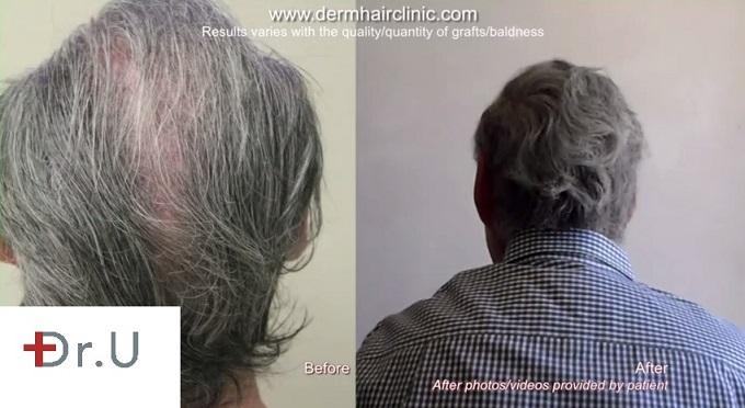 hair density restoration