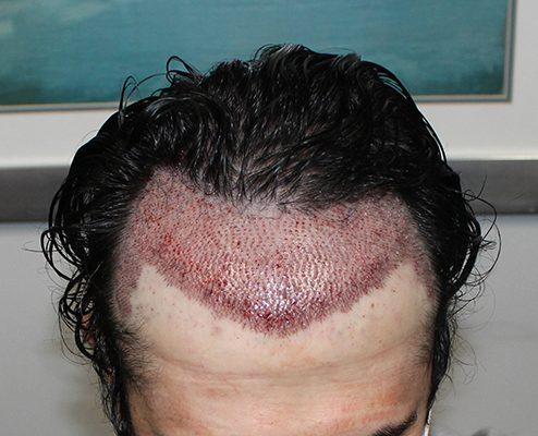 hair transplant